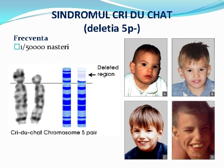 SINDROMUL CRI DU CHAT (deletia 5 p-) Frecventa � 1/50000 nasteri 