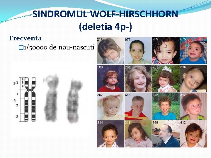 SINDROMUL WOLF-HIRSCHHORN (deletia 4 p-) Frecventa � 1/50000 de nou-nascuti 