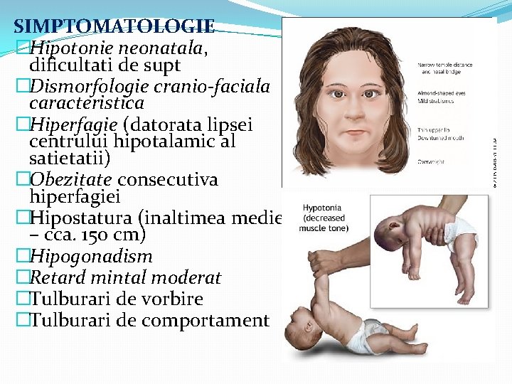 SIMPTOMATOLOGIE �Hipotonie neonatala, dificultati de supt �Dismorfologie cranio-faciala caracteristica �Hiperfagie (datorata lipsei centrului hipotalamic
