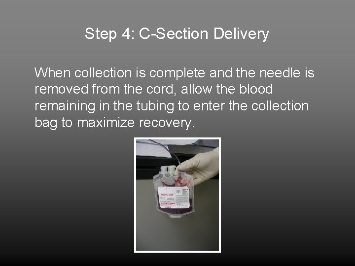 Step 4: C-Section Delivery When collection is complete and the needle is removed from
