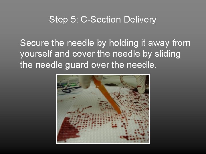 Step 5: C-Section Delivery Secure the needle by holding it away from yourself and