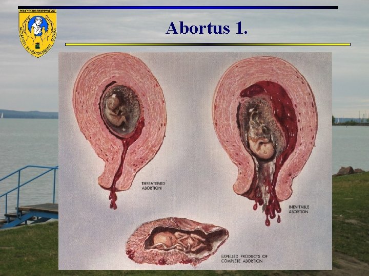 Abortus 1. 