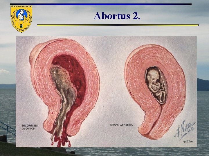 Abortus 2. 