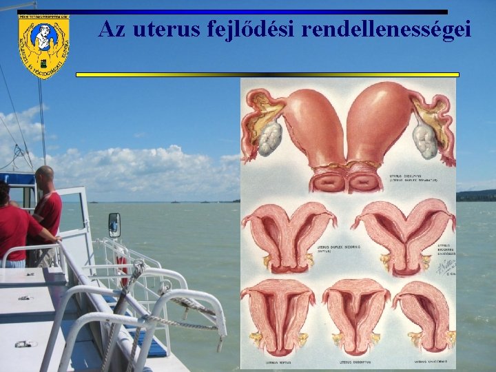 Az uterus fejlődési rendellenességei 