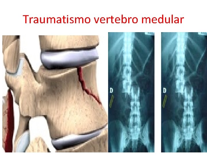 Traumatismo vertebro medular 