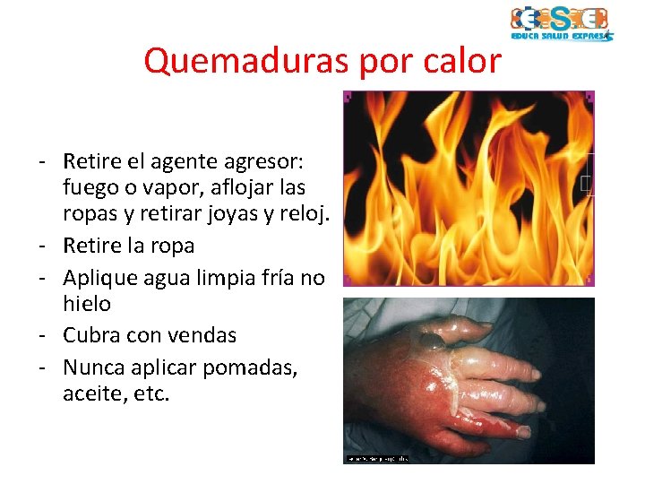 Quemaduras por calor - Retire el agente agresor: fuego o vapor, aflojar las ropas