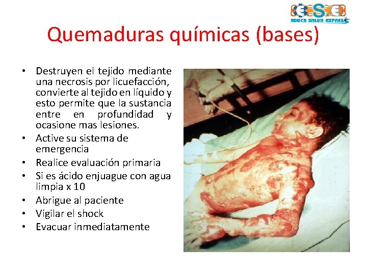 Quemaduras químicas (bases) • Destruyen el tejido mediante una necrosis por licuefacción, convierte al