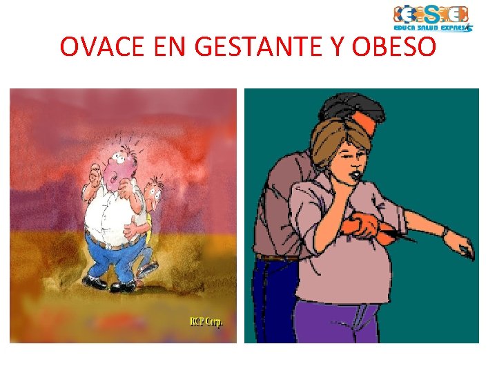 OVACE EN GESTANTE Y OBESO 