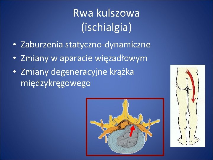 Rwa kulszowa (ischialgia) • Zaburzenia statyczno-dynamiczne • Zmiany w aparacie więzadłowym • Zmiany degeneracyjne