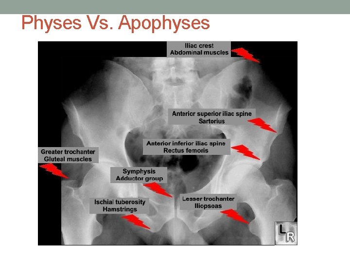 Physes Vs. Apophyses 