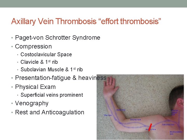 Axillary Vein Thrombosis “effort thrombosis” • Paget-von Schrotter Syndrome • Compression • Costoclavicular Space