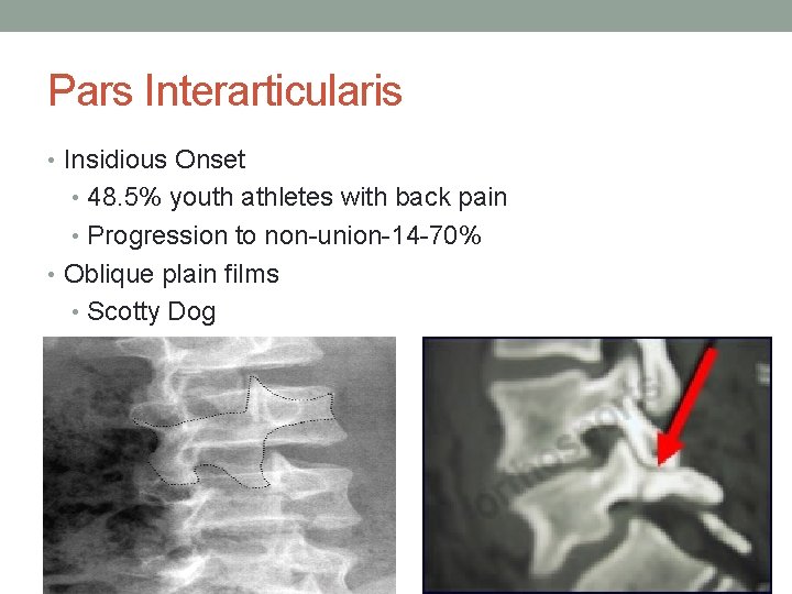 Pars Interarticularis • Insidious Onset • 48. 5% youth athletes with back pain •