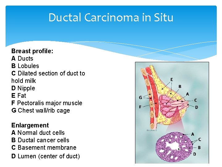 Ductal Carcinoma in Situ Breast profile: A Ducts B Lobules C Dilated section of