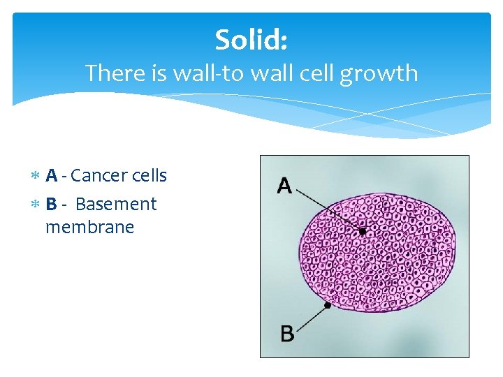 Solid: There is wall-to wall cell growth A - Cancer cells B - Basement