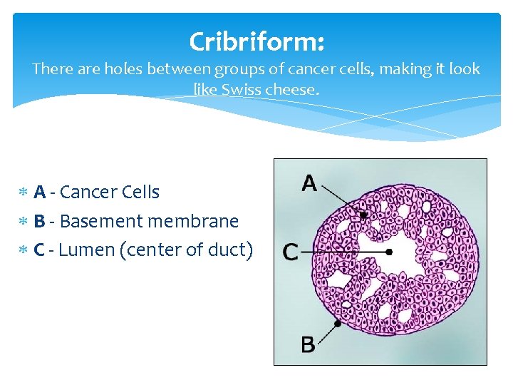Cribriform: There are holes between groups of cancer cells, making it look like Swiss