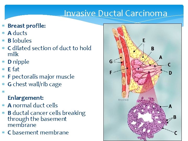 Invasive Ductal Carcinoma Breast profile: A ducts B lobules C dilated section of duct
