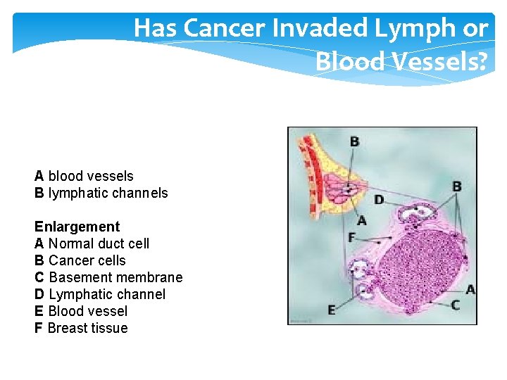 Has Cancer Invaded Lymph or Blood Vessels? A blood vessels B lymphatic channels Enlargement