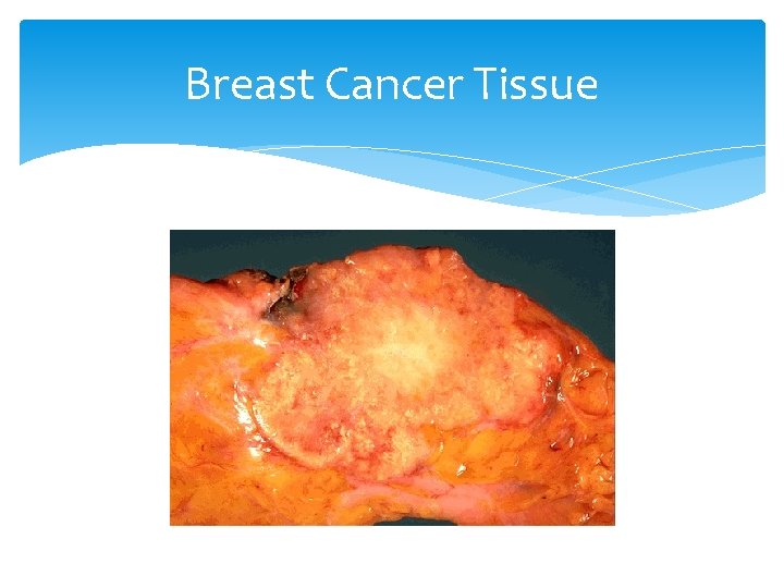 Breast Cancer Tissue 