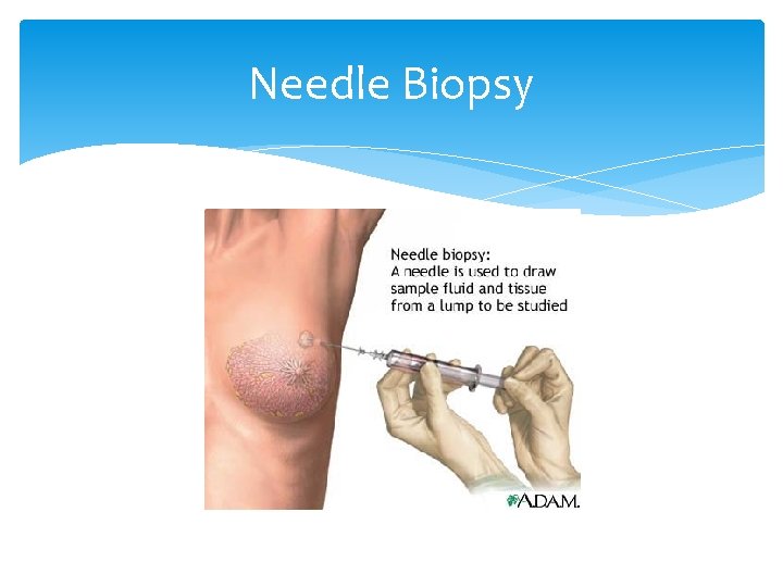 Needle Biopsy 