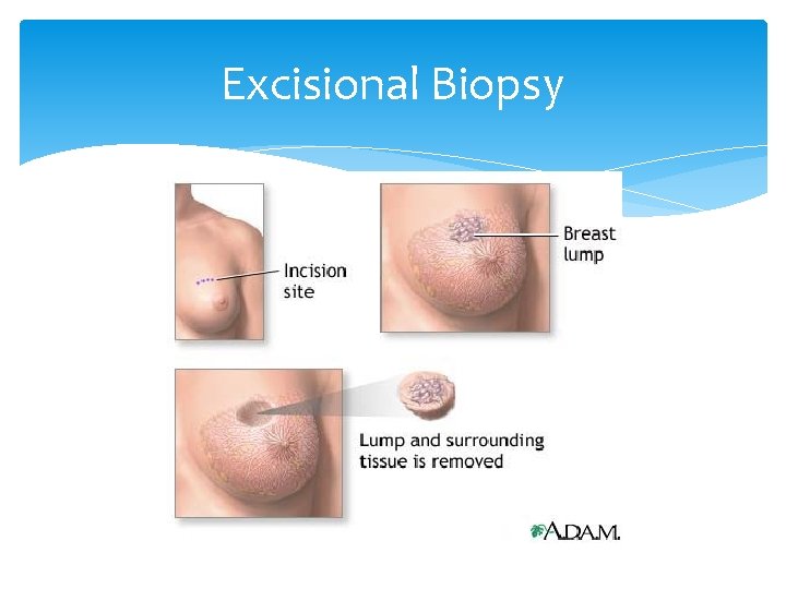 Excisional Biopsy 