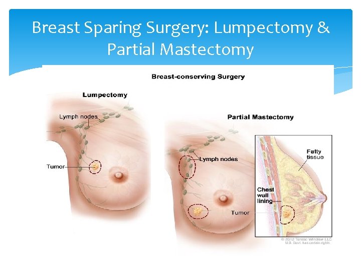 Breast Sparing Surgery: Lumpectomy & Partial Mastectomy 