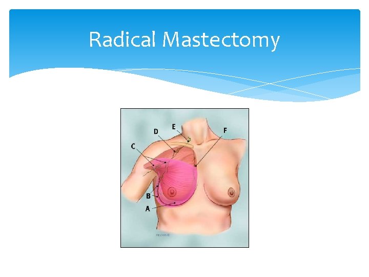 Radical Mastectomy 