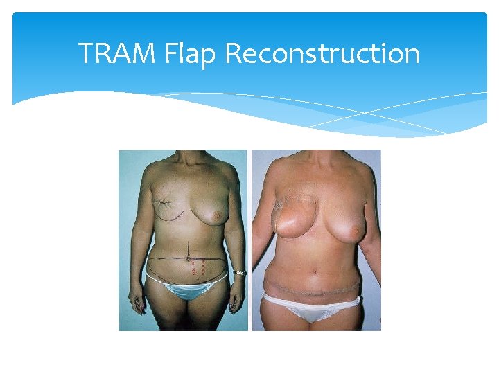 TRAM Flap Reconstruction 