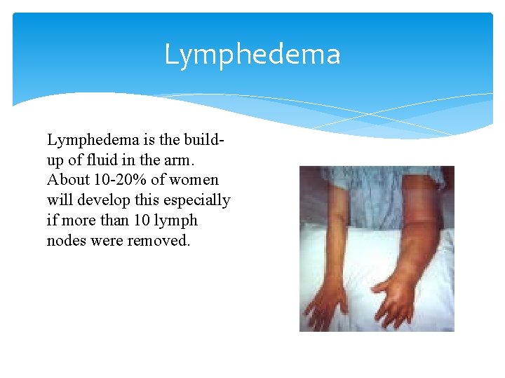 Lymphedema is the buildup of fluid in the arm. About 10 -20% of women