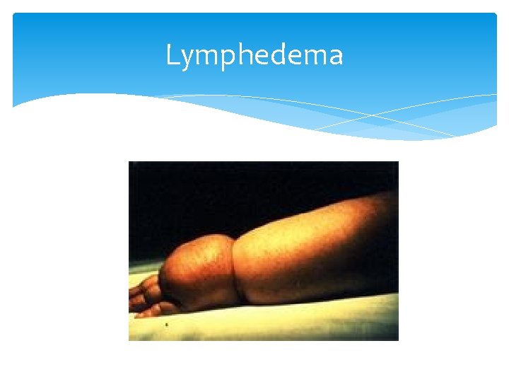Lymphedema 