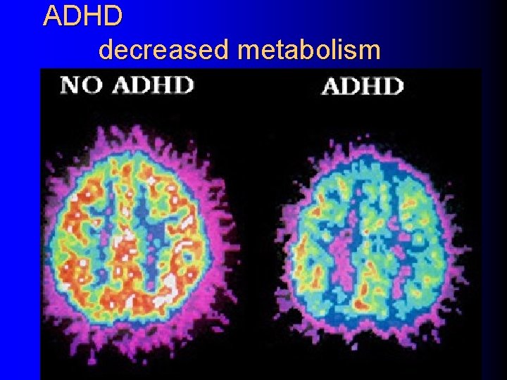 ADHD decreased metabolism 