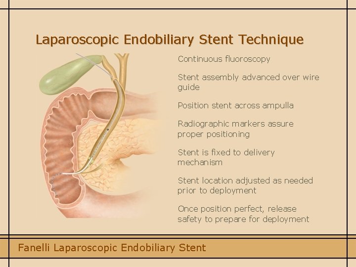Laparoscopic Endobiliary Stent Technique Continuous fluoroscopy Stent assembly advanced over wire guide Position stent