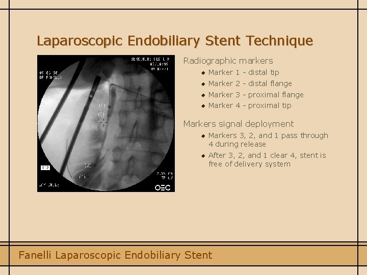 Laparoscopic Endobiliary Stent Technique Radiographic markers u Marker 1 - distal tip u Marker