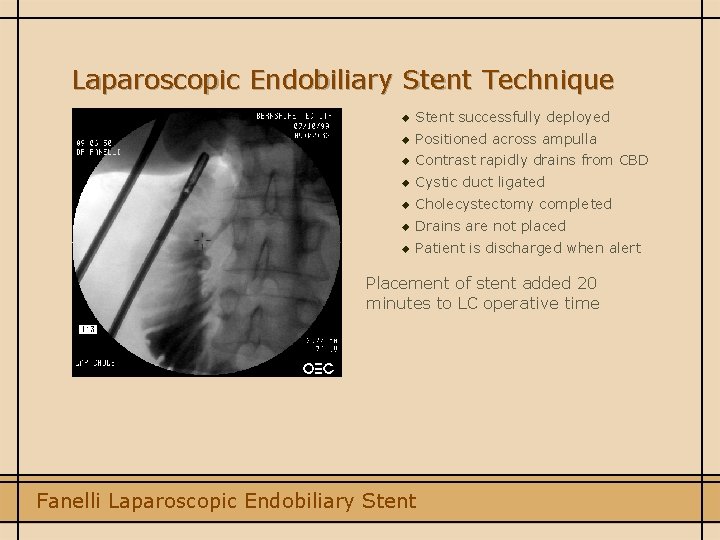 Laparoscopic Endobiliary Stent Technique u Stent successfully deployed u Positioned across ampulla u Contrast