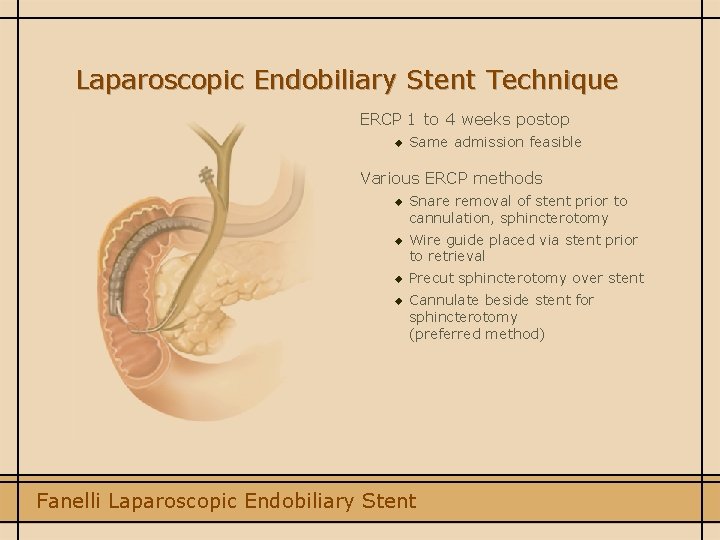 Laparoscopic Endobiliary Stent Technique ERCP 1 to 4 weeks postop u Same admission feasible