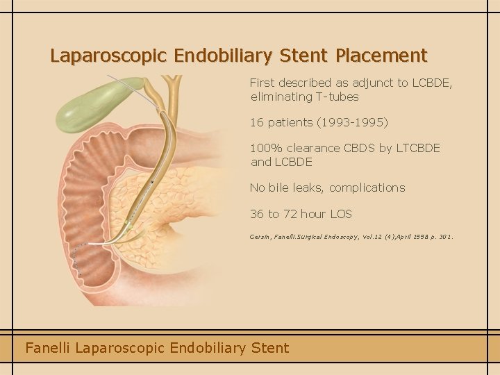 Laparoscopic Endobiliary Stent Placement First described as adjunct to LCBDE, eliminating T-tubes 16 patients