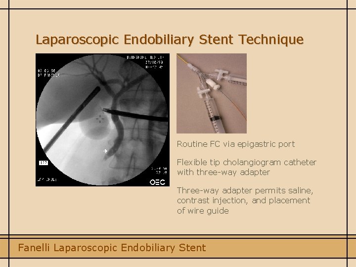 Laparoscopic Endobiliary Stent Technique Routine FC via epigastric port Flexible tip cholangiogram catheter with