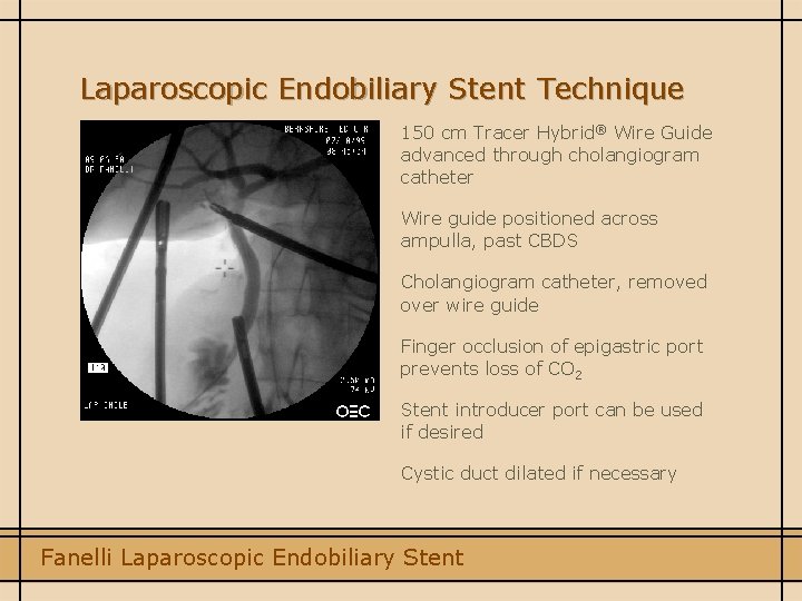 Laparoscopic Endobiliary Stent Technique 150 cm Tracer Hybrid® Wire Guide advanced through cholangiogram catheter