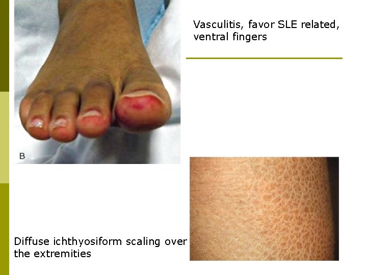 Vasculitis, favor SLE related, ventral fingers Diffuse ichthyosiform scaling over the extremities 