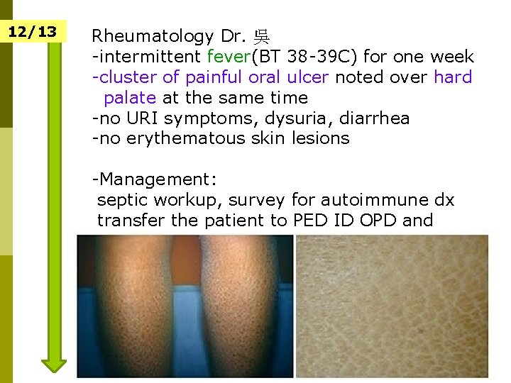 12/13 Rheumatology Dr. 吳 -intermittent fever(BT 38 -39 C) for one week -cluster of