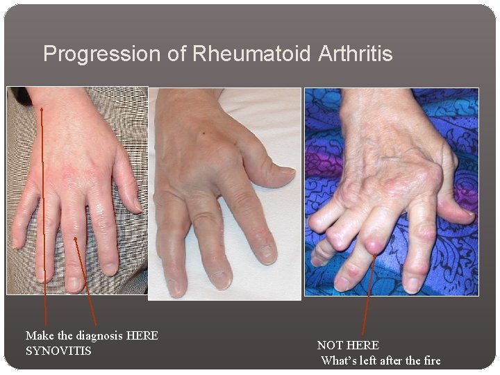 Progression of Rheumatoid Arthritis Make the diagnosis HERE SYNOVITIS NOT HERE What’s left after