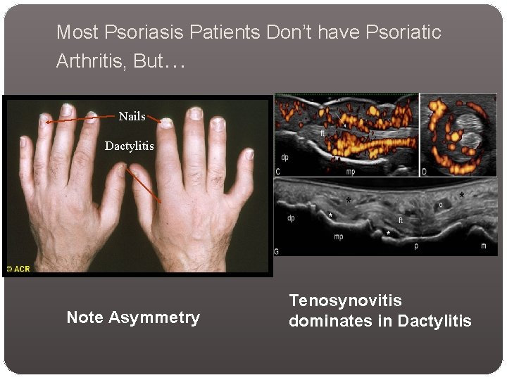 Most Psoriasis Patients Don’t have Psoriatic Arthritis, But… Nails Dactylitis Note Asymmetry Tenosynovitis dominates