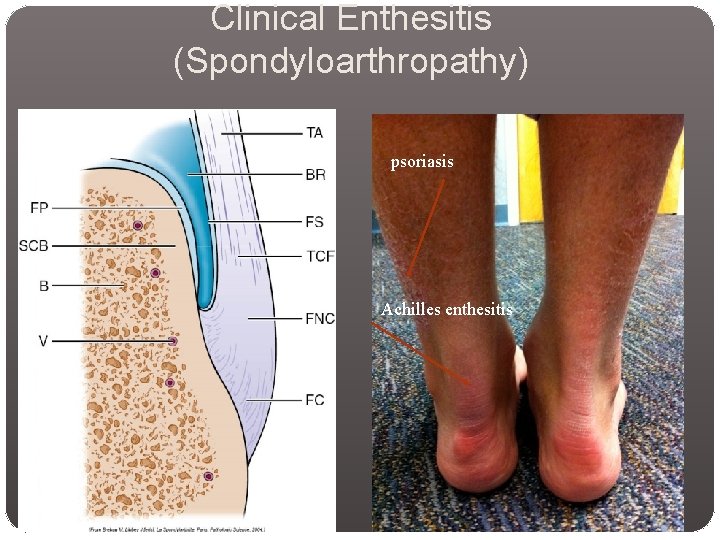 Clinical Enthesitis (Spondyloarthropathy) psoriasis Achilles enthesitis 