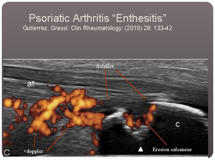 Psoriatic Arthritis “Enthesitis” Gutierrez, Grassi: Clin Rheumatology: (2010) 29: 133 -42 Achilles +doppler Erosion