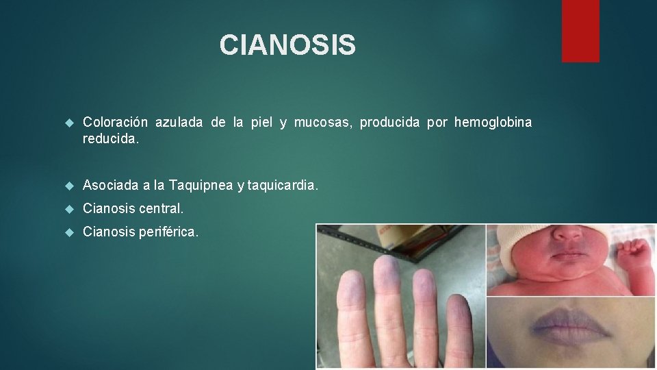 CIANOSIS Coloración azulada de la piel y mucosas, producida por hemoglobina reducida. Asociada a