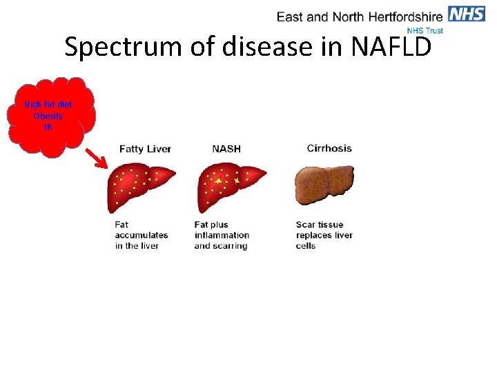 Spectrum of disease in NAFLD High fat diet Obesity IR 