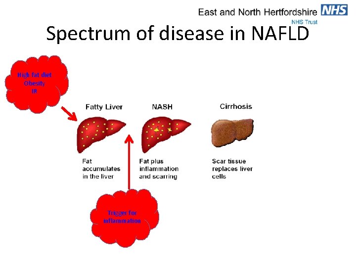 Spectrum of disease in NAFLD High fat diet Obesity IR Trigger for inflammation 
