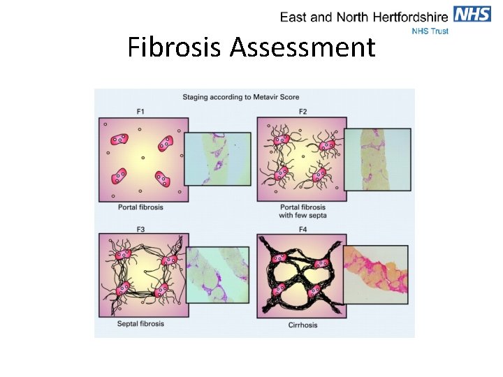 Fibrosis Assessment 