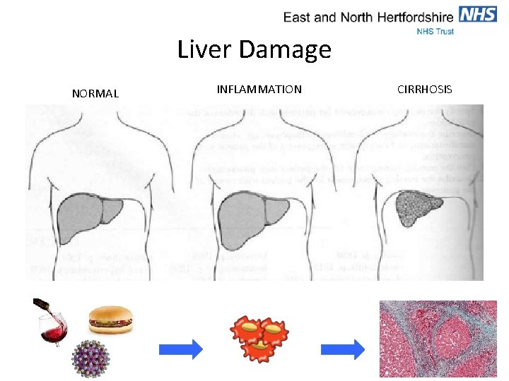 Liver Damage NORMAL INFLAMMATION CIRRHOSIS 