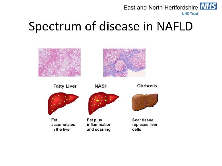 Spectrum of disease in NAFLD 
