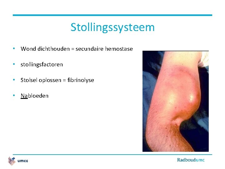 Stollingssysteem • Wond dichthouden = secundaire hemostase • stollingsfactoren • Stolsel oplossen = fibrinolyse